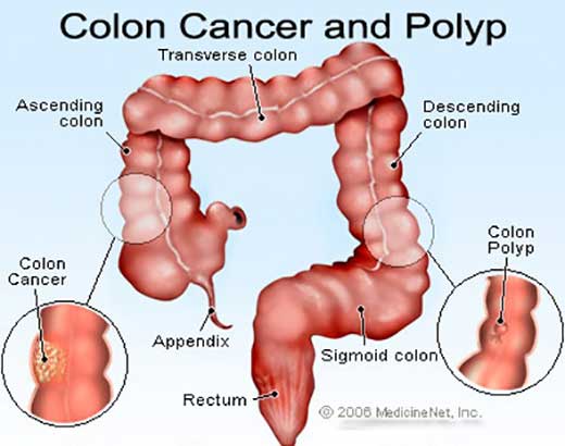 Colon cancer